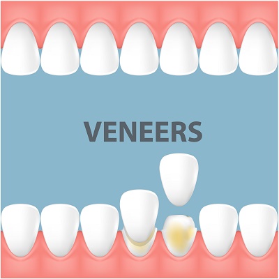 Read more about the article Veneers