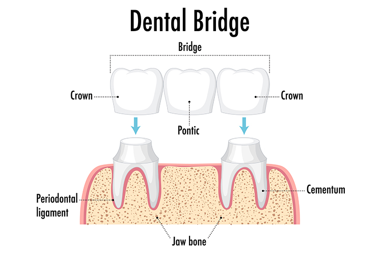 Read more about the article Dental Crown and Bridges