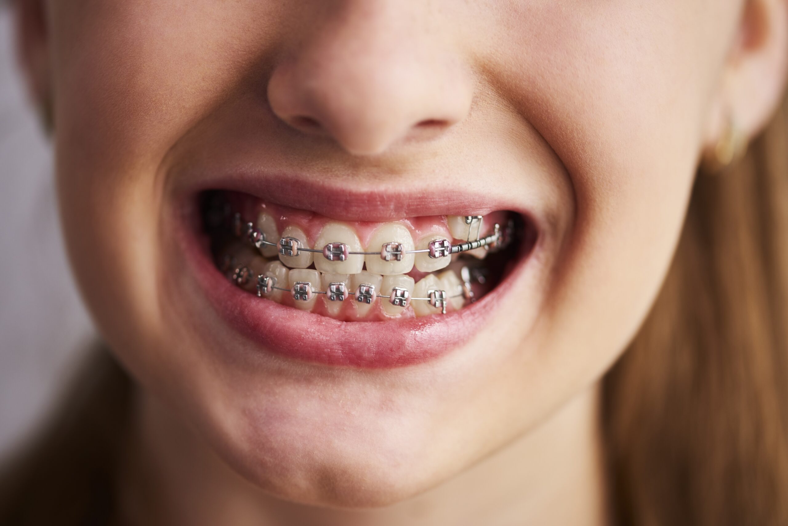 Read more about the article Tooth Alignment